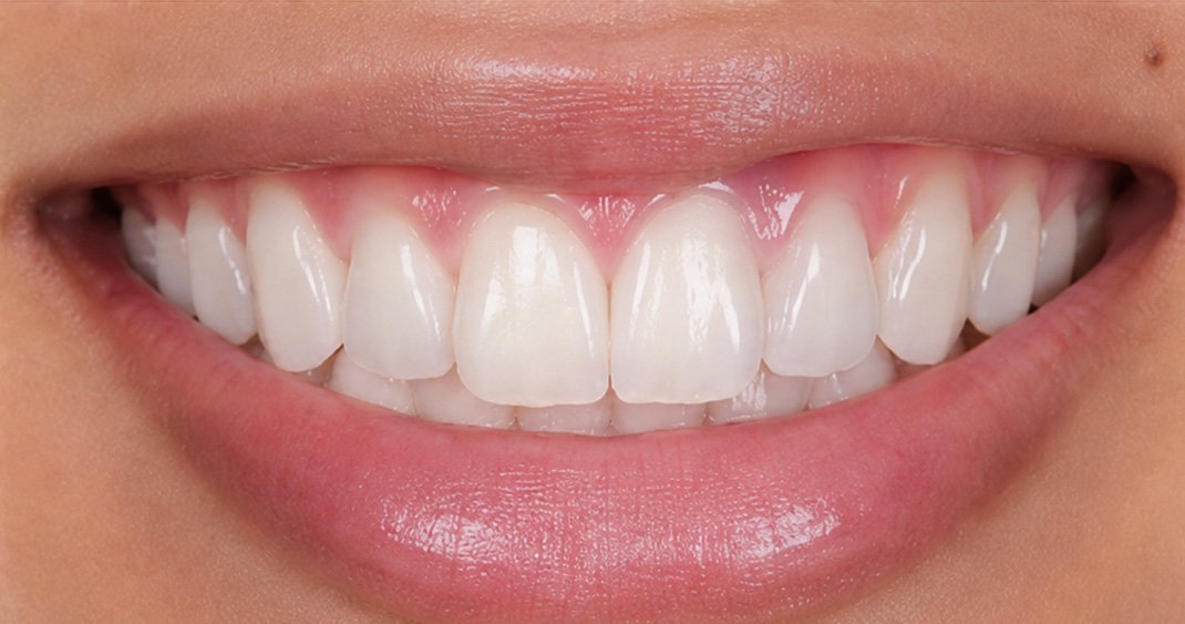 Close-up clinical after view showing a perfectly aligned and healthy straight smile