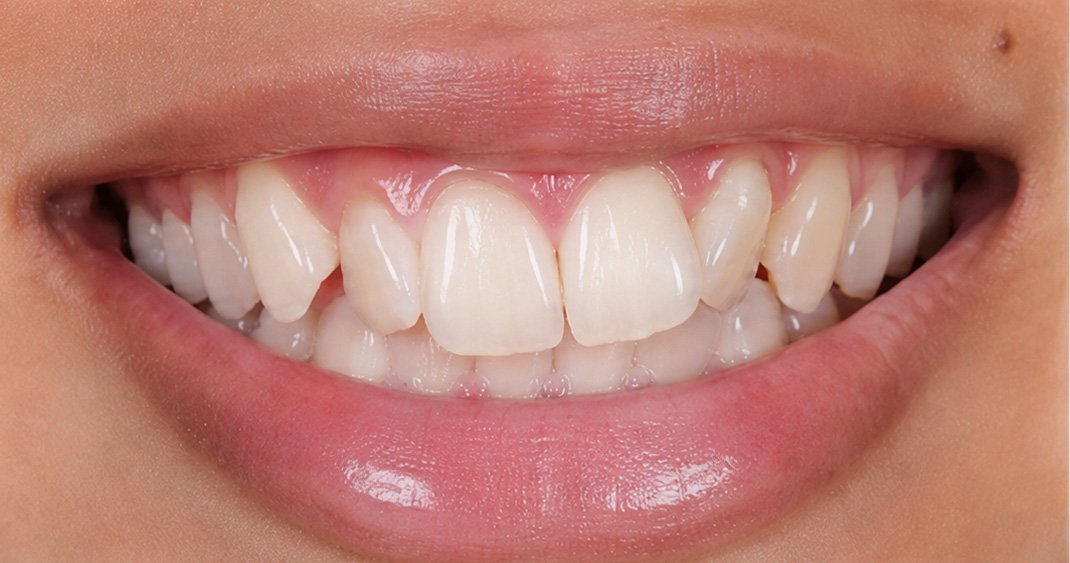 Close-up clinical before view showing upper teeth crowding and misalignment