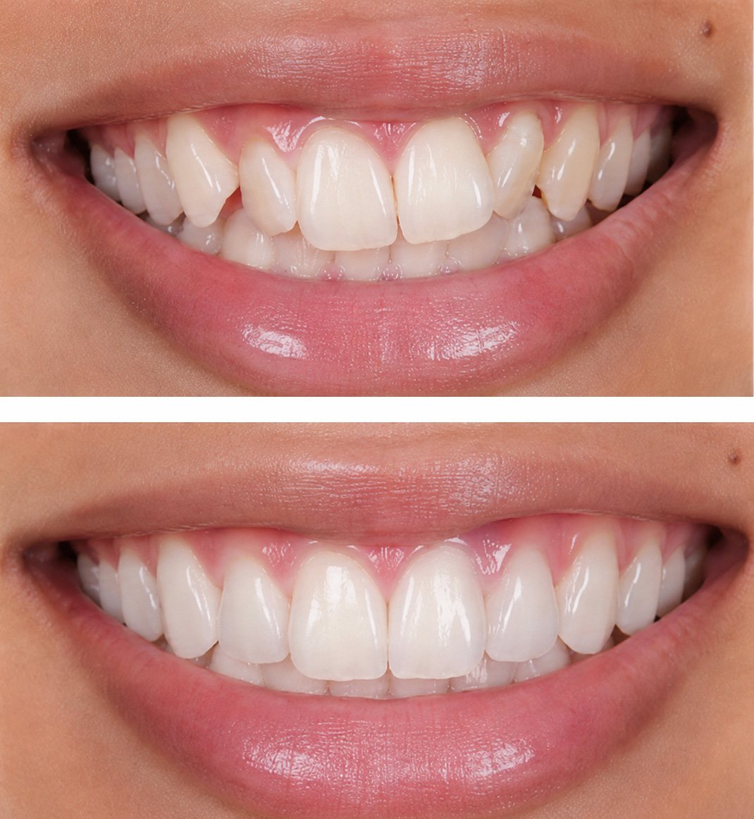 Split clinical view comparing crowded upper teeth before treatment and aligned smile after orthodontics