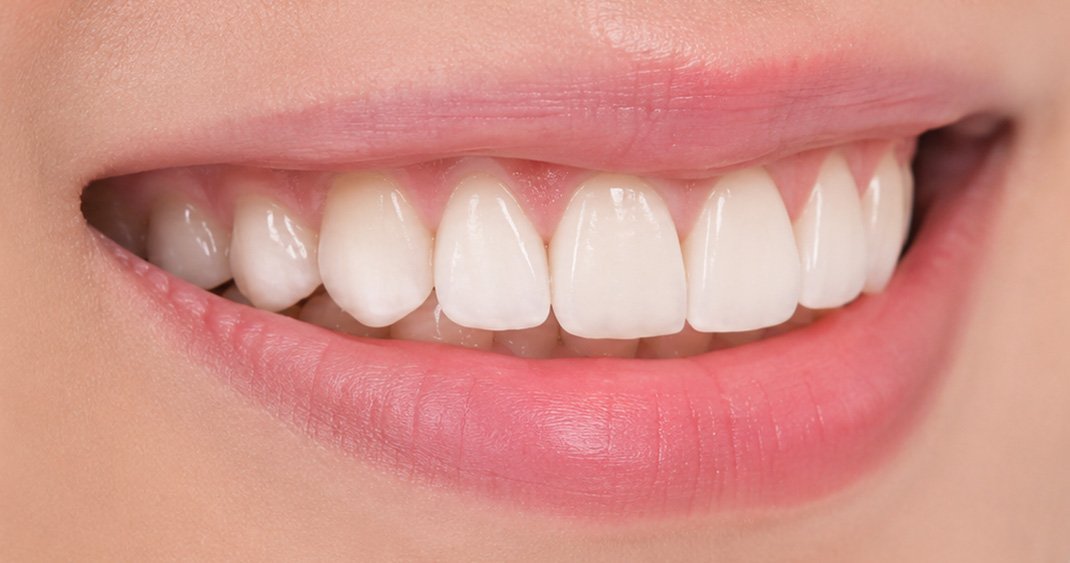 Side angle clinical after view showing a smooth and beautifully aligned smile line