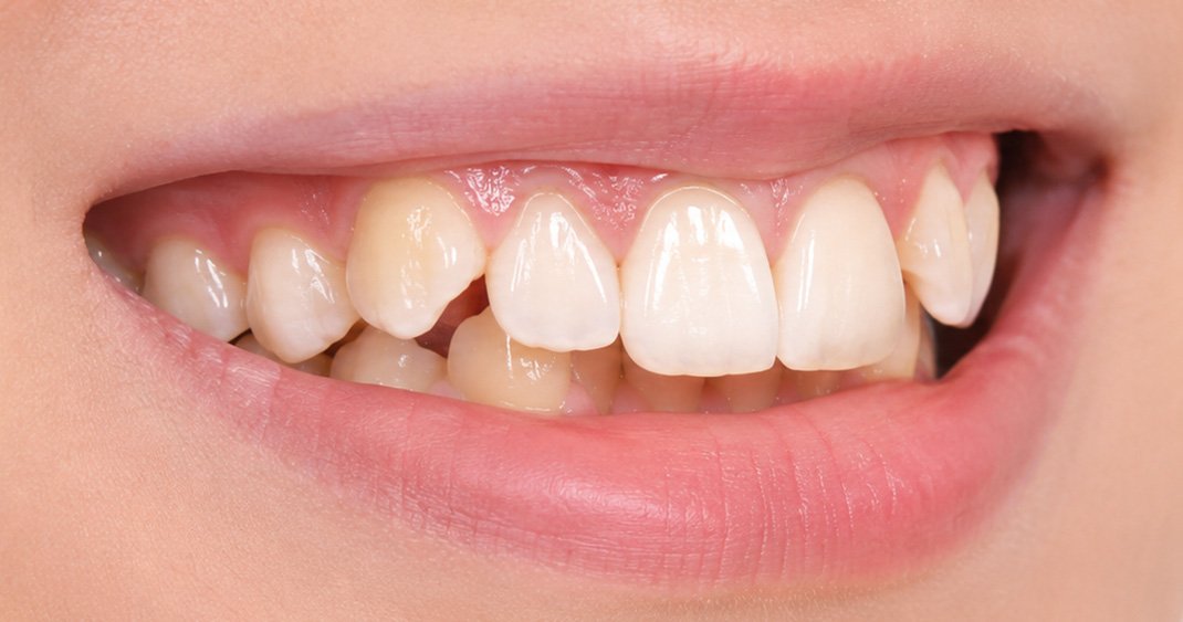Side angle clinical before view showing severe tooth crowding and rotation