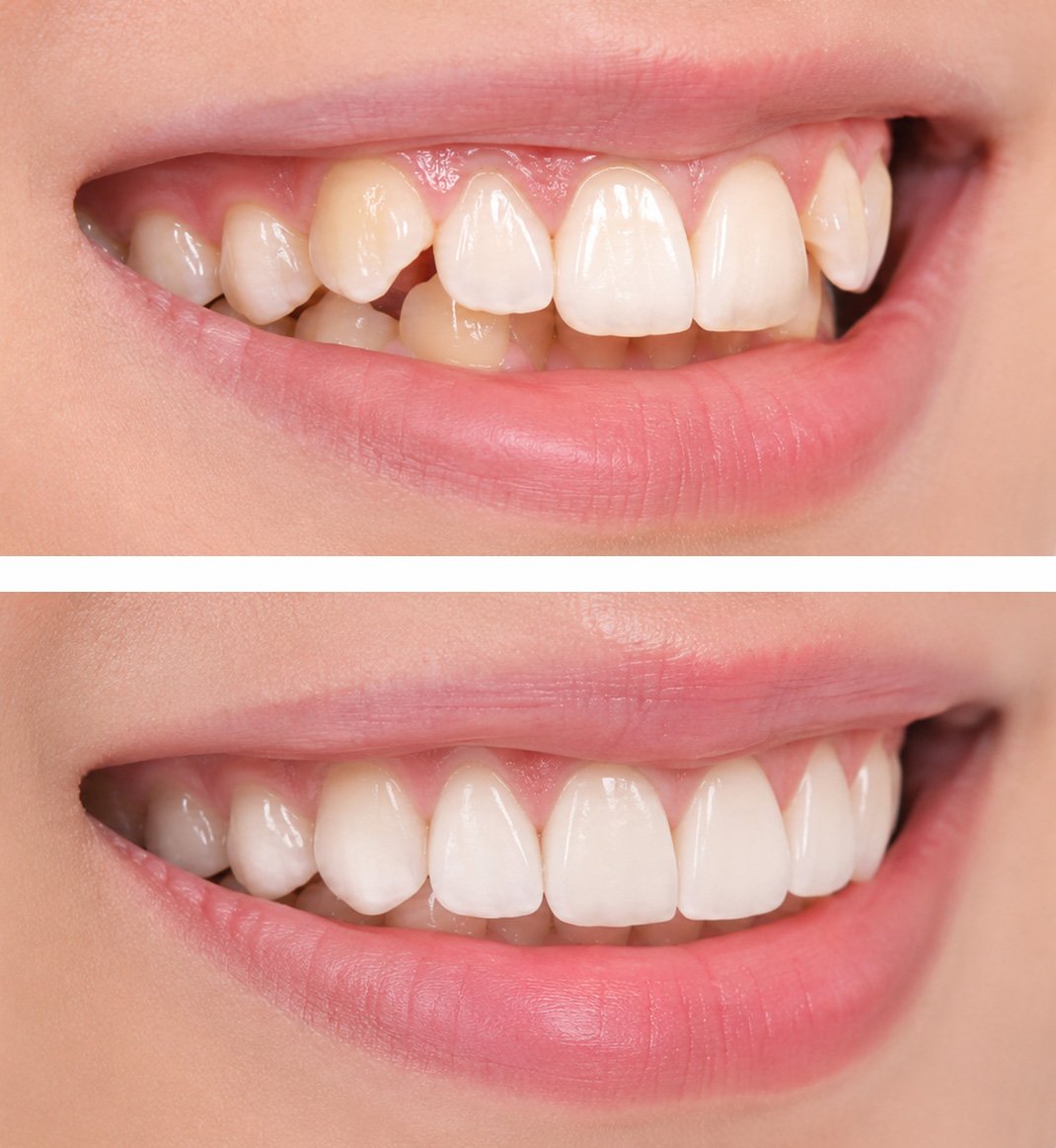 Side angle split clinical view comparing severe tooth crowding before treatment and beautifully aligned smile line after orthodontics